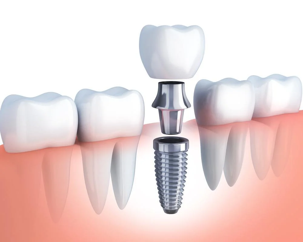Dental Implants 