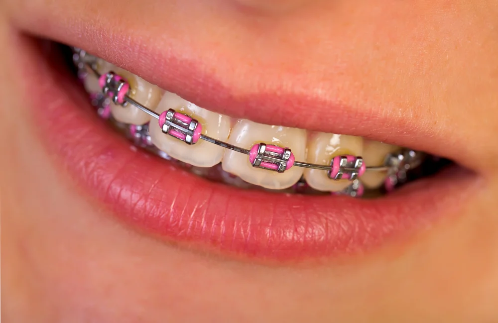 Braces 